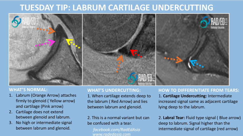 shoulder cartilage labrum undercutting mri fellowship radiology education asia radedasia