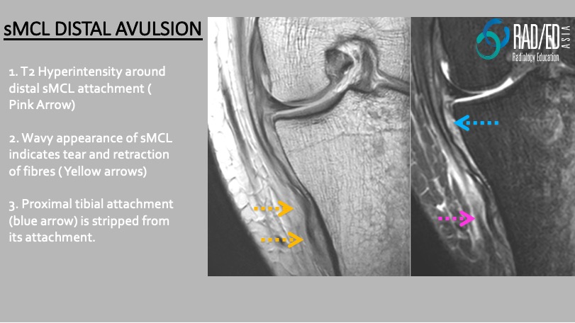 sMCL: DONT FORGET THE DISTAL ATTACHMENT – Radiology Education Asia