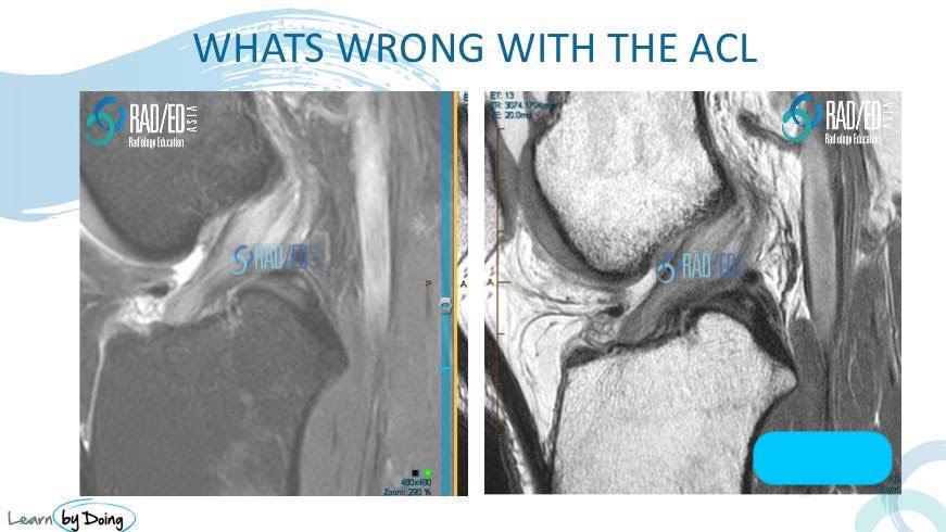 MUCOID DEGENERATION QUIZ – Radiology Education Asia