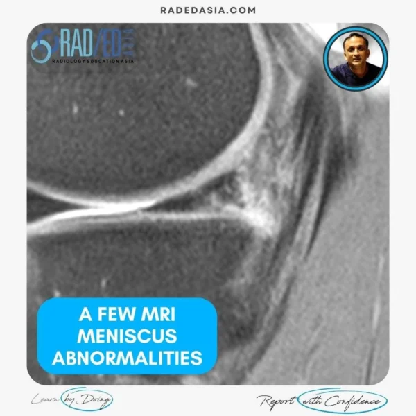 mri knee meniscus tears cysts pathologies images