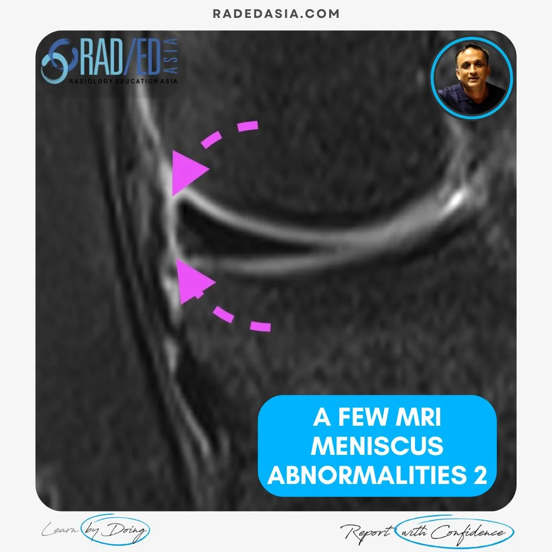 mri-knee-meniscus-degeneration-maceration-flap-tear-extrusion-meniscocapsular-separation-radedasia